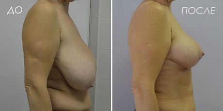 Редукционная маммопластика