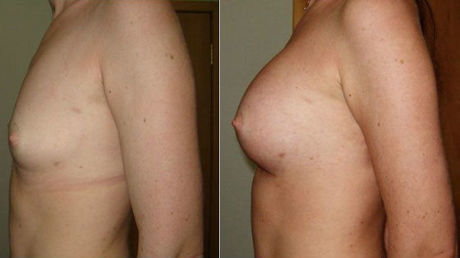 Подтяжка груди: фото до и псоле