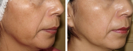 Омоложение ЭЛОС