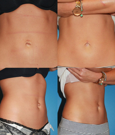 Умбиликопластика - цели и показания к проведению