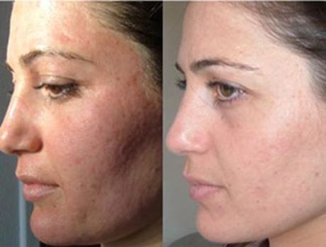 Механизм действия газожидкостного пилинга