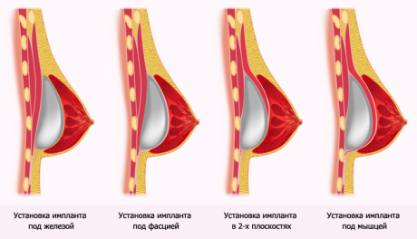 грудные импланты