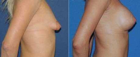 пластике тубулярной груди