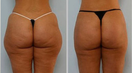 Цены на безоперационную липосакцию