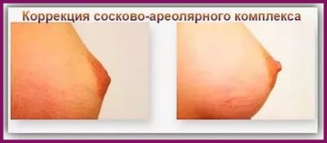 Пластика сосково-ареорального комплекса