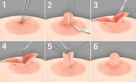 Пластика сосково-ареорального комплекса