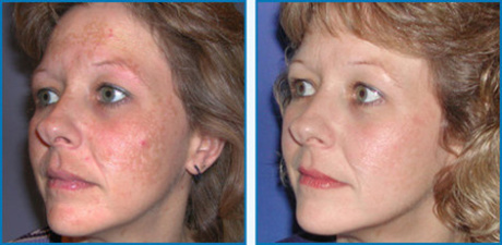 Дермабразия - механический пилинг кожи