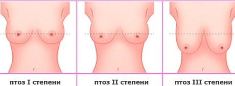 Степени (стадии) птоза