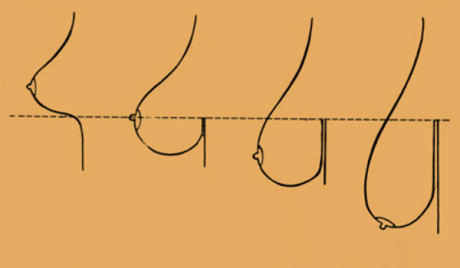 Что может спровоцировать развитие птоза?