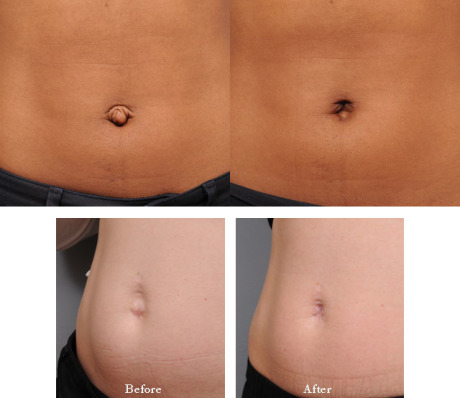 Умбиликопластика - цели и показания к проведению