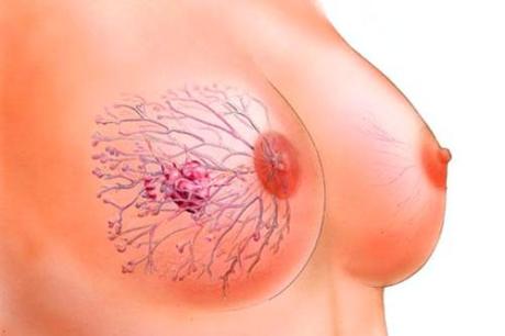 Гипертрофия молочных желез