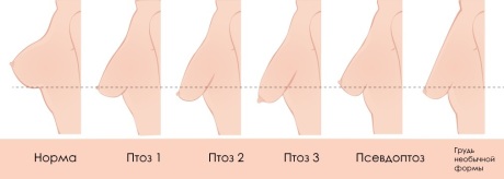 Степени птоза