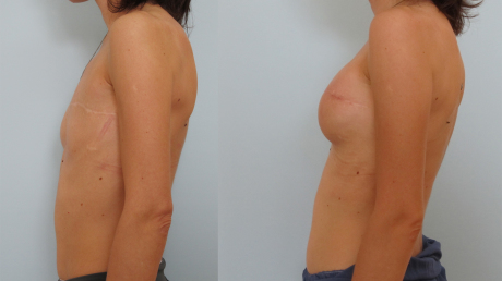 Варианты восстановления молочных желез