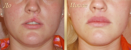 Пластика губ