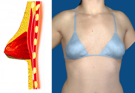 По каким причинам может сформироваться тубулярная грудь