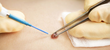 Профилактика и лечение новообразований