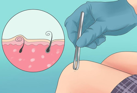 Как избавиться от вросших волос