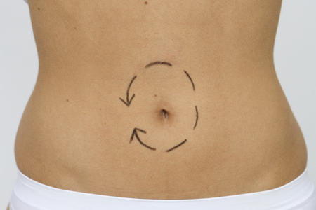 umbilikoplastika