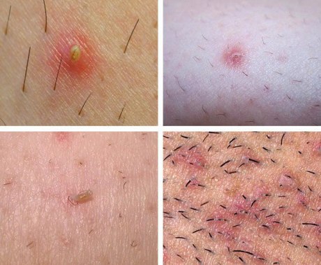 Как избавиться от вросших волос