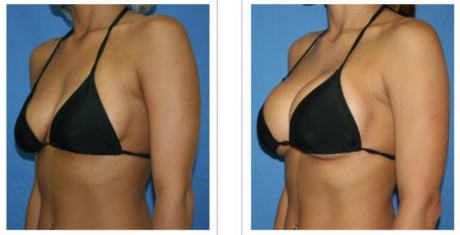 Грудные импланты «Ментор»