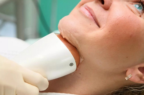 Аппаратные методы липосакции подбородка