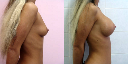 Балкизов Вячеслав Валерьевич. Фото до и после операций3-1