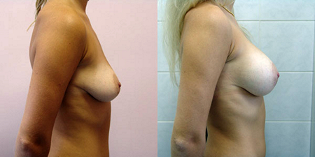 Балкизов Вячеслав Валерьевич. Фото до и после операций3-3