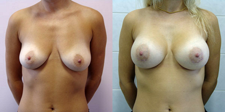 Балкизов Вячеслав Валерьевич. Фото до и после операций3