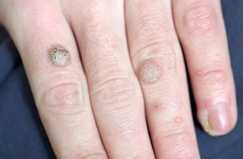 Бородавки вирусного происхождения