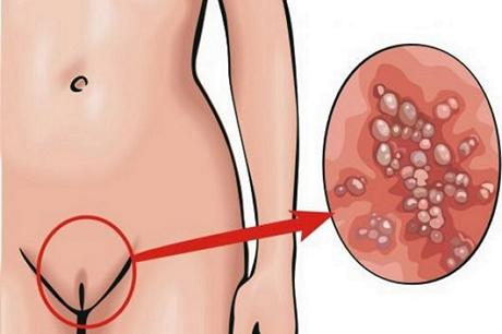 Вирусные аногенитальные папилломы