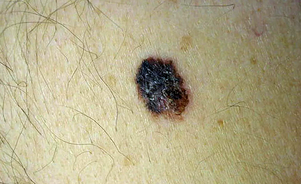 Другие разновидности новообразований