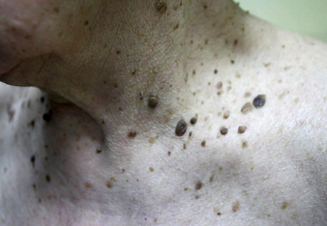 Кератомы или старческие бородавки