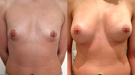 Крысин Дмитрий Викторович. Результаты увеличения груди