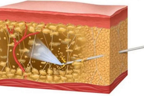 Липосакция водоструйная
