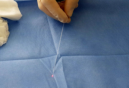 Метод лазерной липосакции