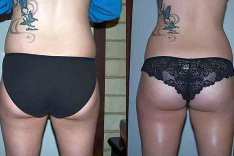 Безоперационная липосакция: отзывы пациентов