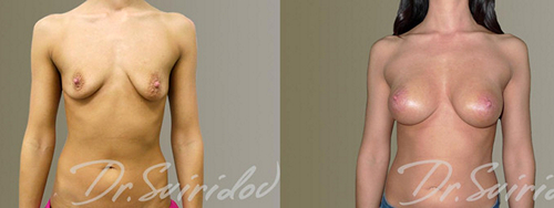 Свиридов Сергей Владимирович. Фото до и после операций по авторской методике