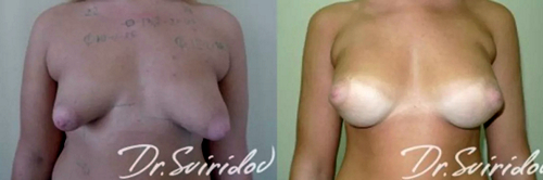 Свиридов Сергей Владимирович. Фото до и после операций по авторской методике2