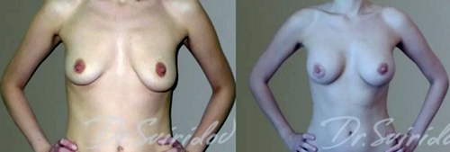 Свиридов Сергей Владимирович. Фото до и после операций по авторской методике3