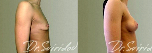 Хирург: Свиридов Сергей Владимирович. Авторская методика «Грудь без шва»