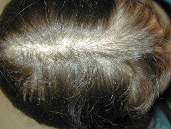 Себорейная алопеция