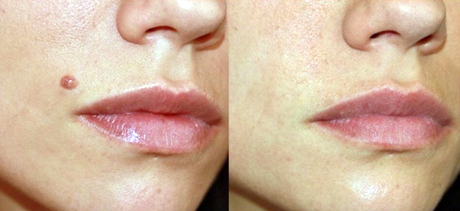 Стоит ли удалять папилломы и бородавки