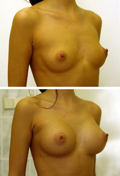 Хирург: Якимец Валерий Григорьевич . Эндоскопическое увеличение груди, анатомические импланты