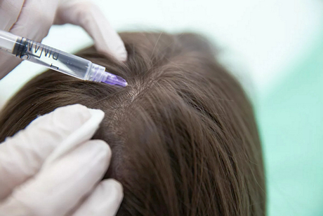 мезотерапия волос