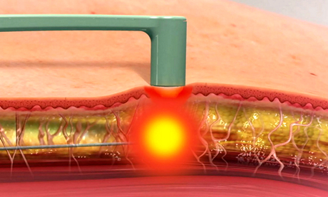 Липосакция с применением энергии радиочастотных волн