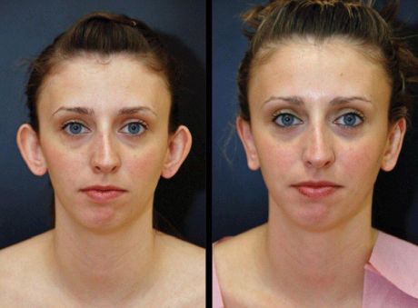 Пластика ушных раковин