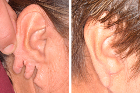 Отопластика: до и после