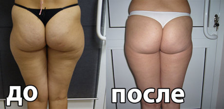 Пластика бедер - результат