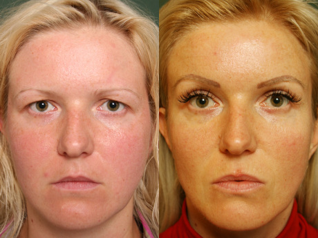 Результат подтяжки бровей и лба