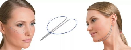 Методика нитевой подтяжки лица